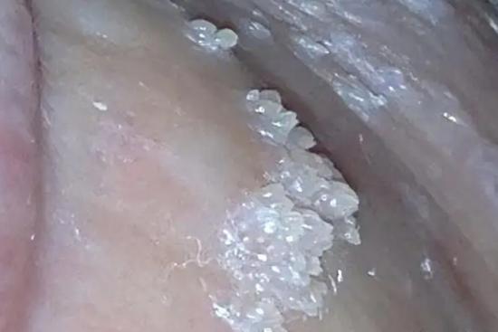 尖锐湿疣醋酸白试验阳性图