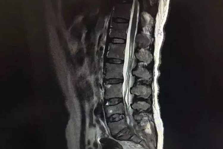 乳腺癌骨转移图