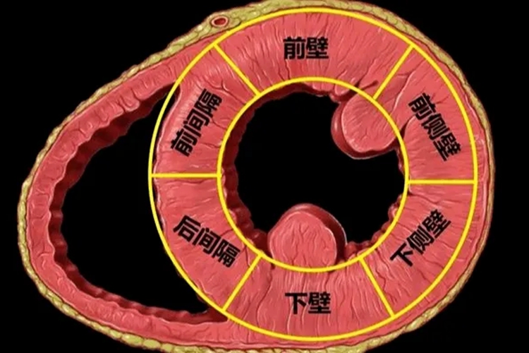 心肌梗死最常见的部位图