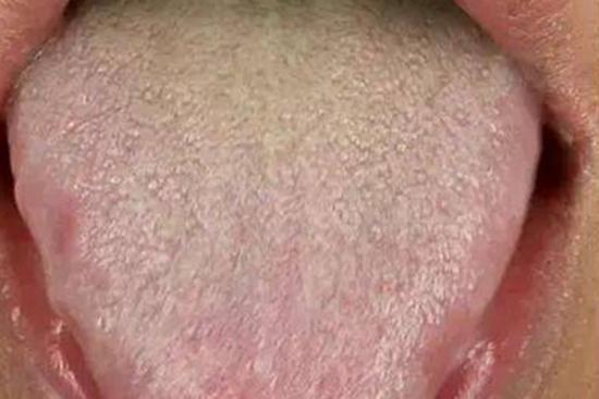 肝气郁结舌苔图