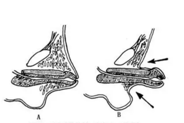隐匿性阴茎挤压试验示意图