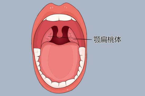 扁桃体123度图片图片