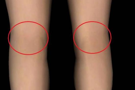 腘窝位置图 腘窝位置图