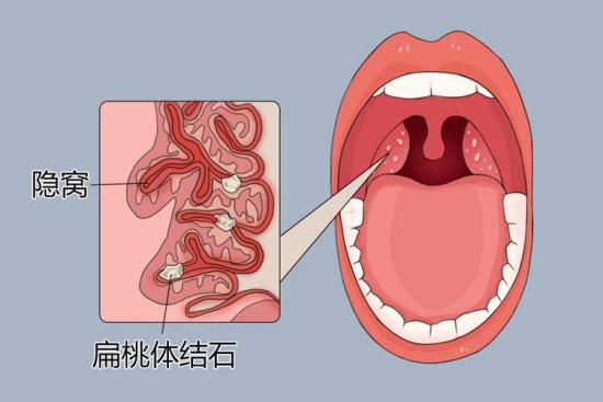 扁桃体隐窝凸起小肉芽图片