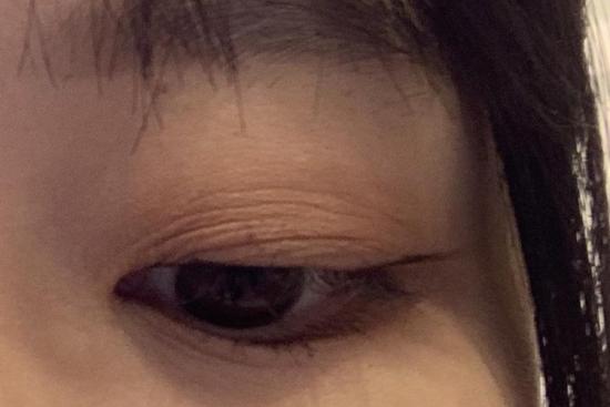 多层褶皱双眼皮图