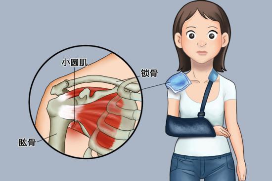 小圆肌撕脱图
