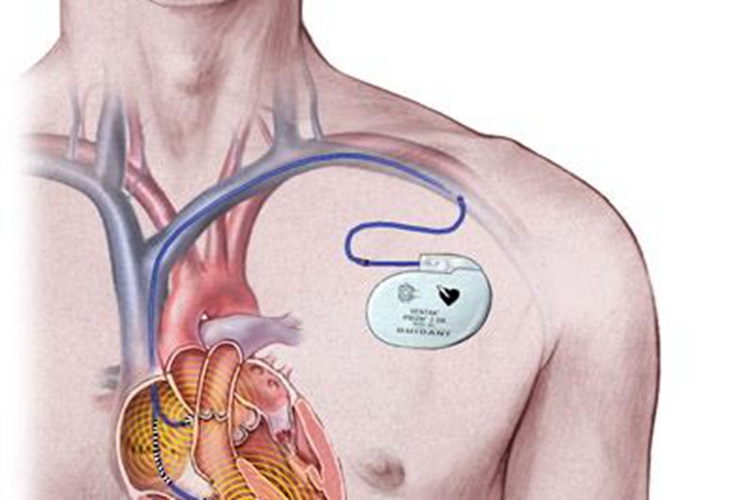 起搏器安装位置图 起搏器安装位置图