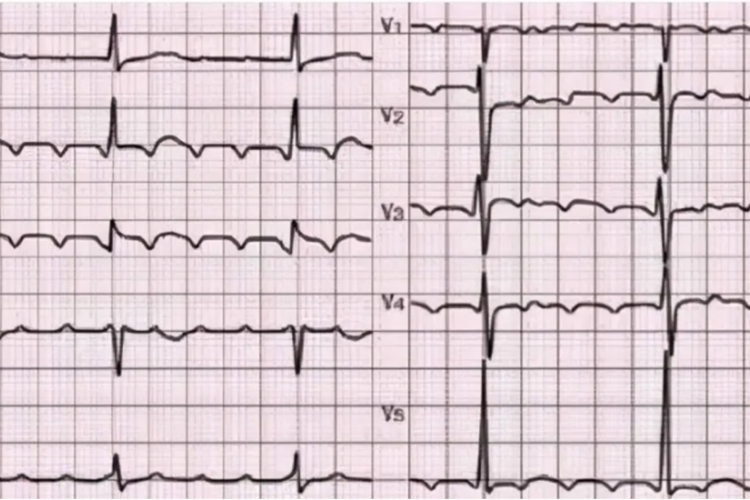 心房扑动心电图 心房扑动心电图