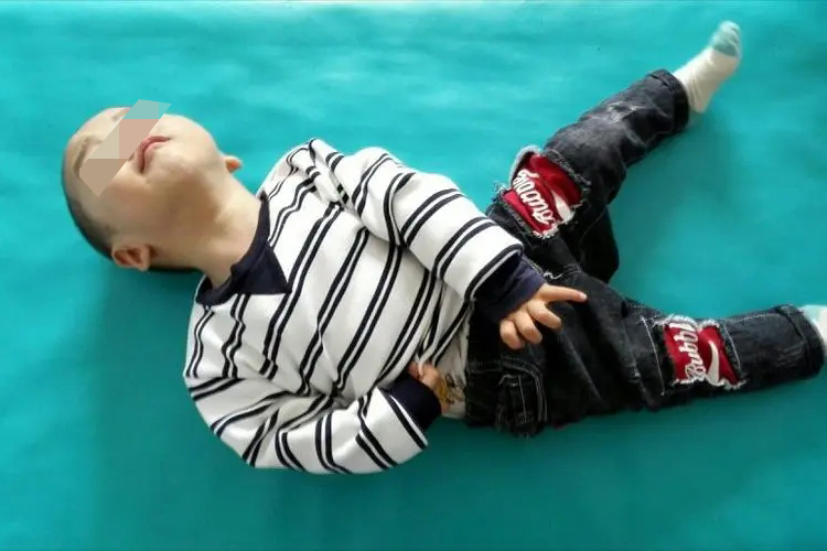 痉挛型脑瘫婴儿睡姿图睡姿调整对于非对称性紧张性颈反射的治疗,目前