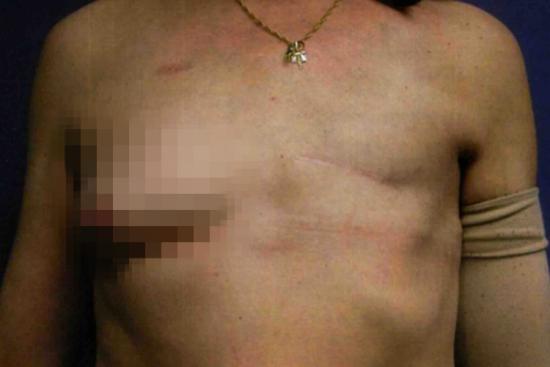 单侧全乳房切除术后乳房外观图