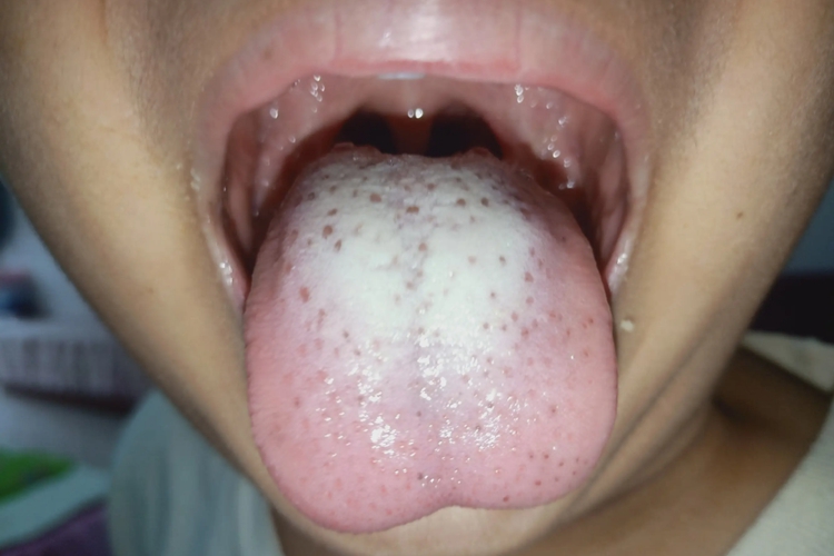 积食舌苔图 积食舌苔图