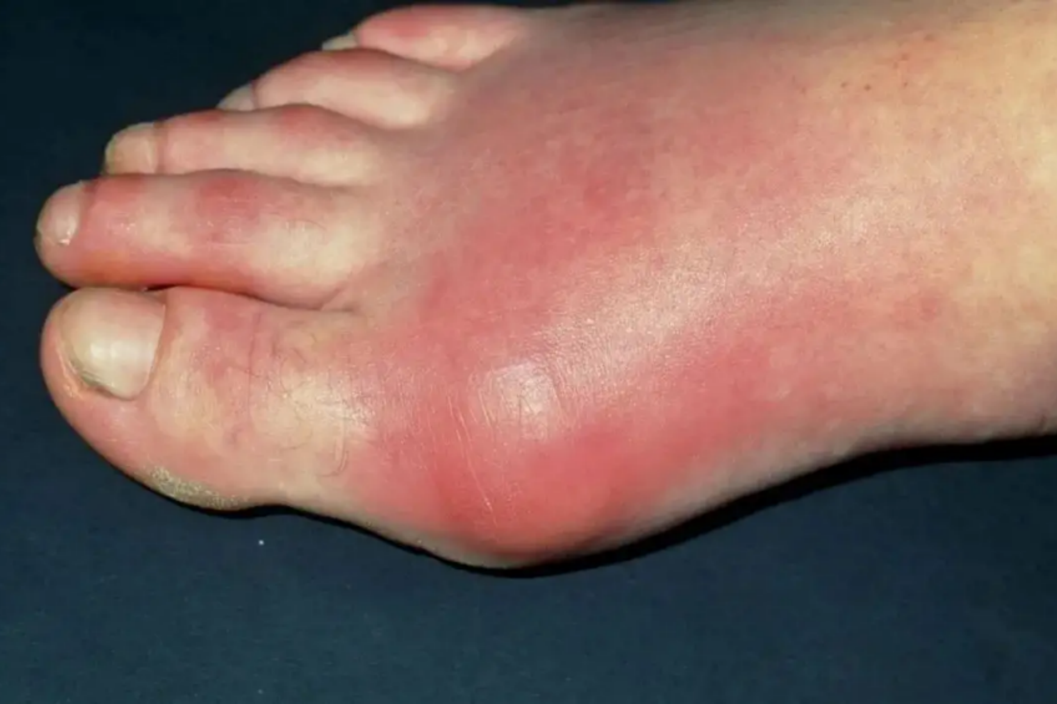 尿酸高第一跖趾关节疼痛图