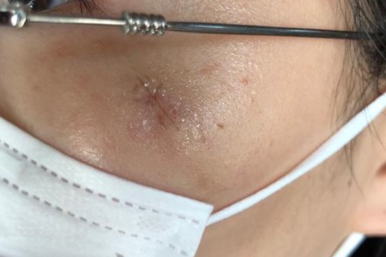 脸上囊肿切除疤痕图