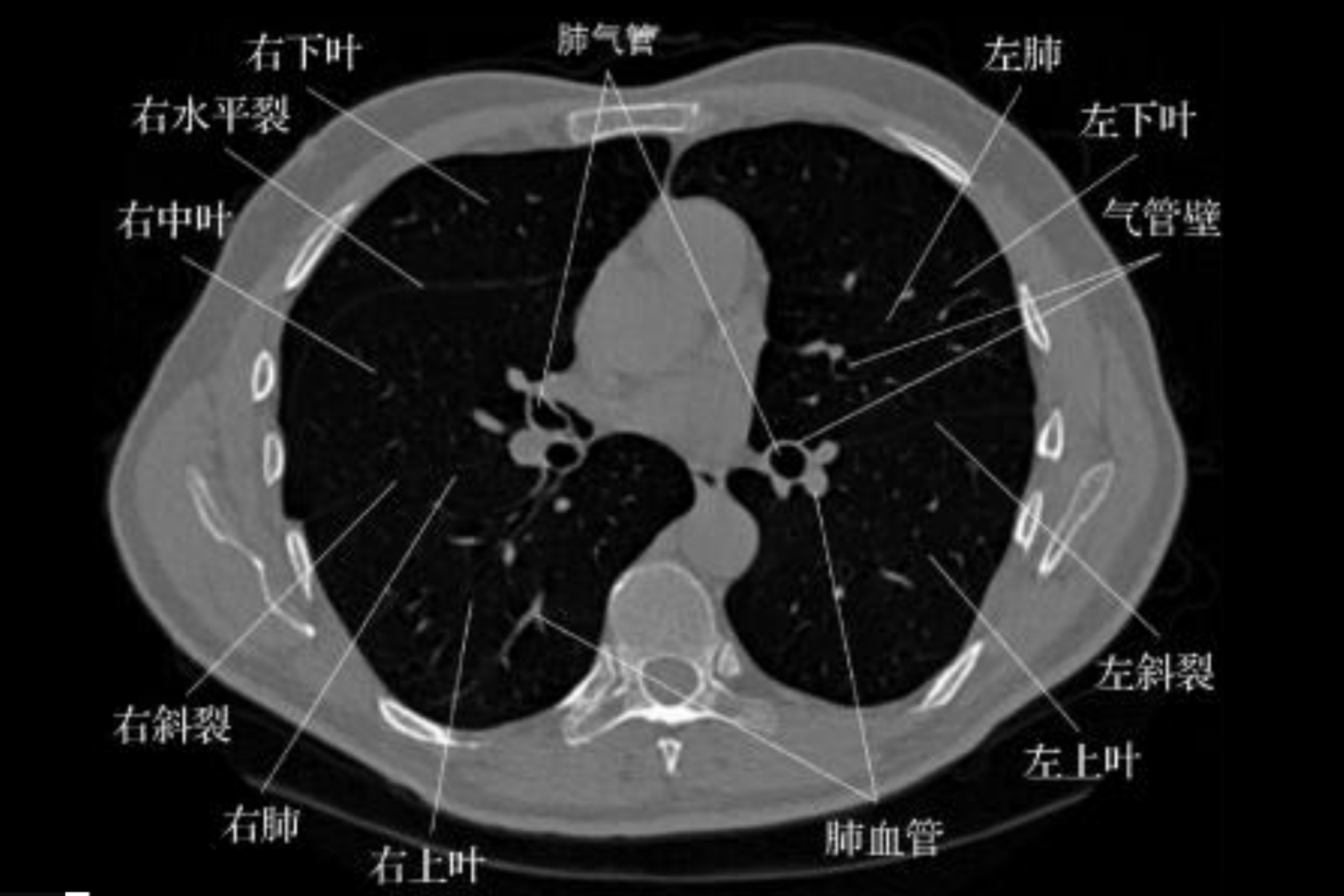 正常肺部CT图像