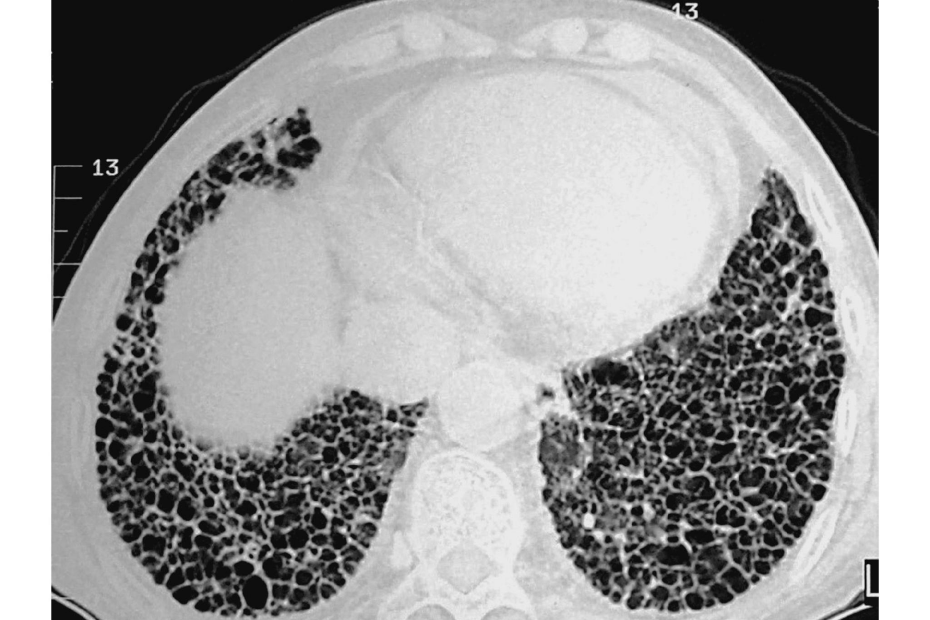肺气肿CT图