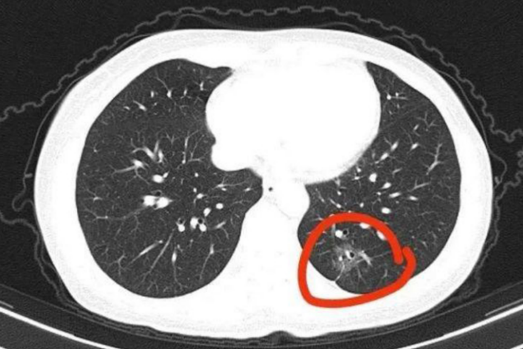 早期肺癌ct图