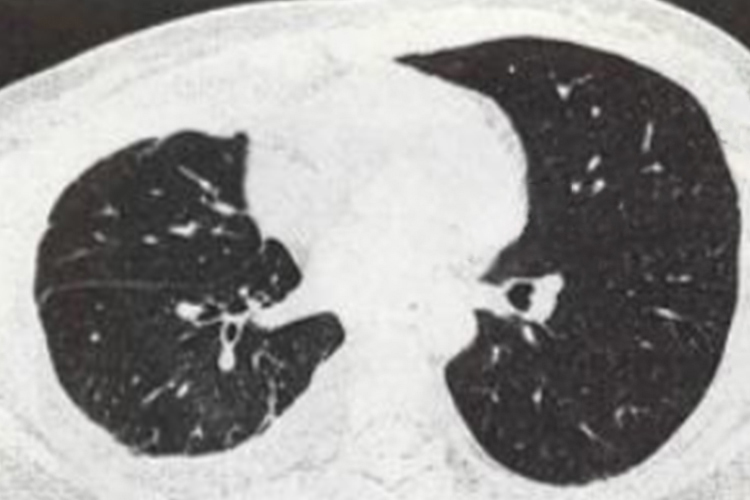 肺结核CT图