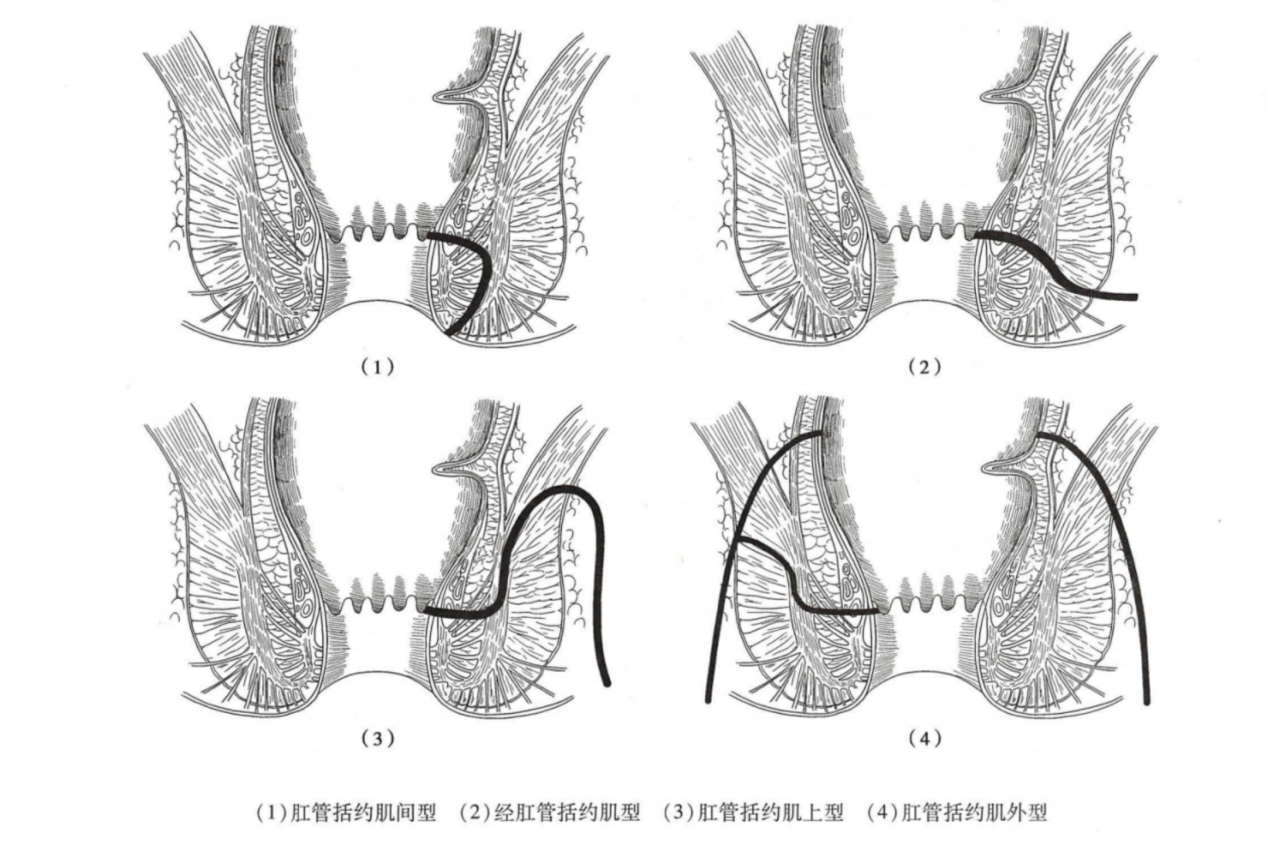 肛瘘生长位置图