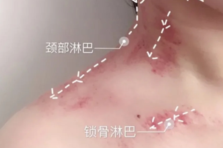 脖子前面右侧淋巴出痧图