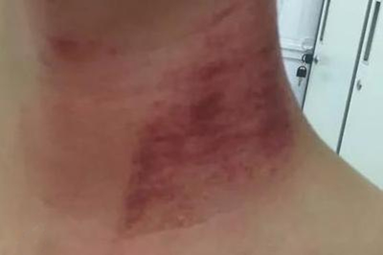 脖子前面左侧淋巴出痧图