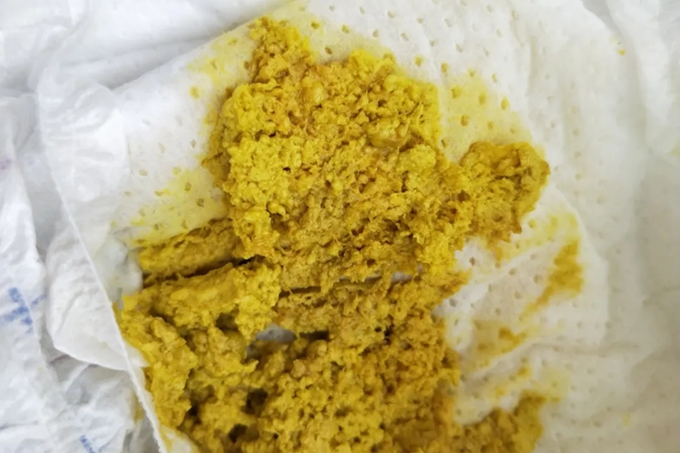 奶粉喂养大便图