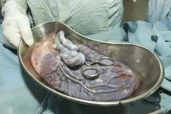 正常胎盘真实图