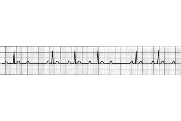 二度I型房室传导阻滞心电图