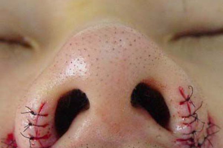 鼻翼缩小后即刻图