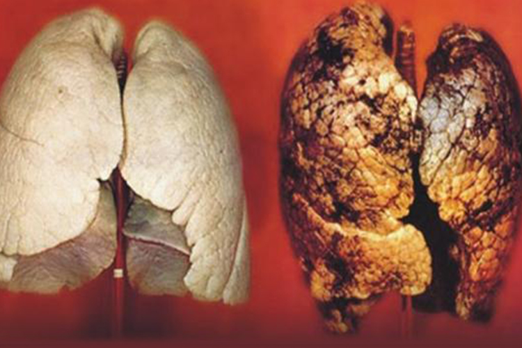 解剖下吸烟者肺与正常肺对比图