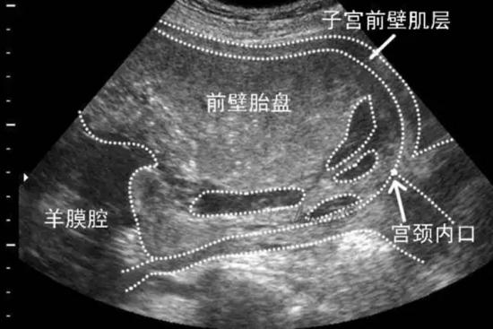 胎盘前壁影像图