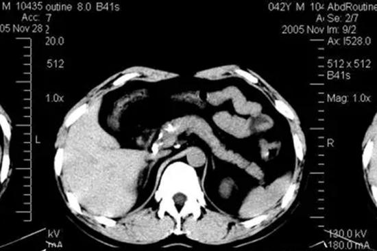 胰腺CT图
