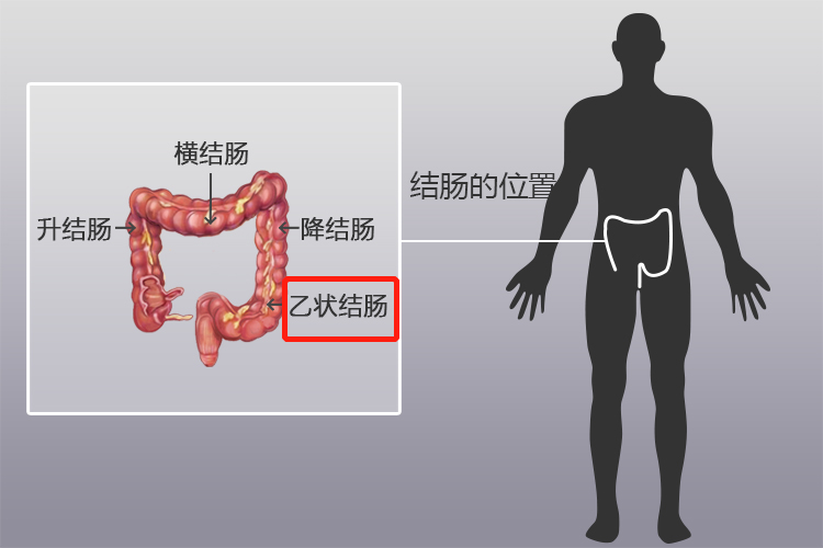 乙状结肠位置图