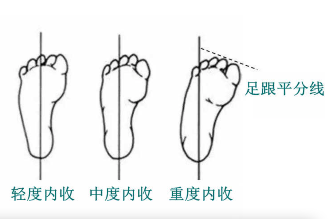 内八字严重程度判断图