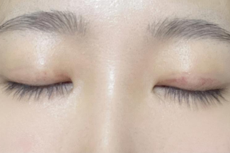 双眼皮埋线恢复七天轻微充血图 双眼皮埋线恢复七天轻微充血图
