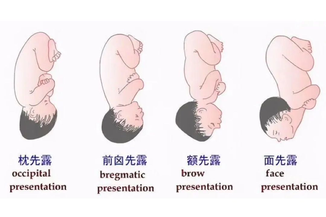 胎儿头位示意图