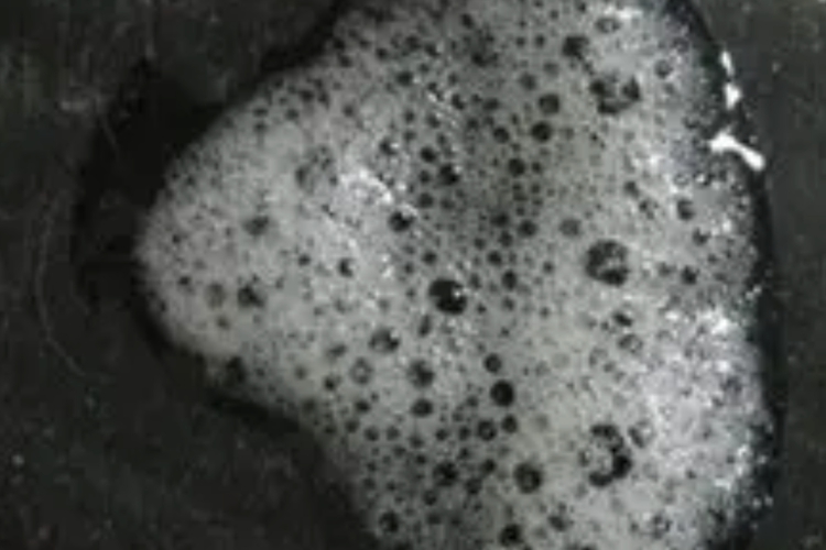 泡沫状痰液图 泡沫状痰液图