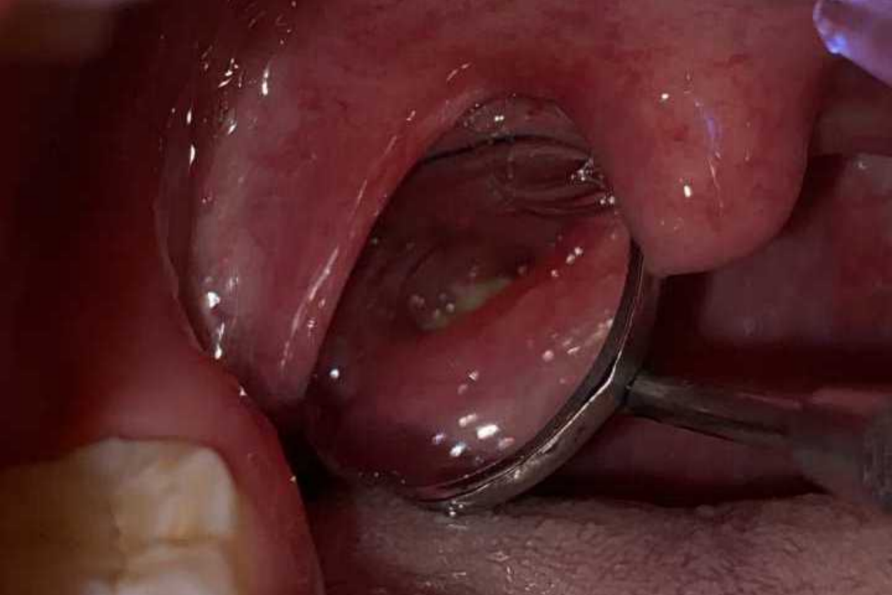 扁桃体结石自检图