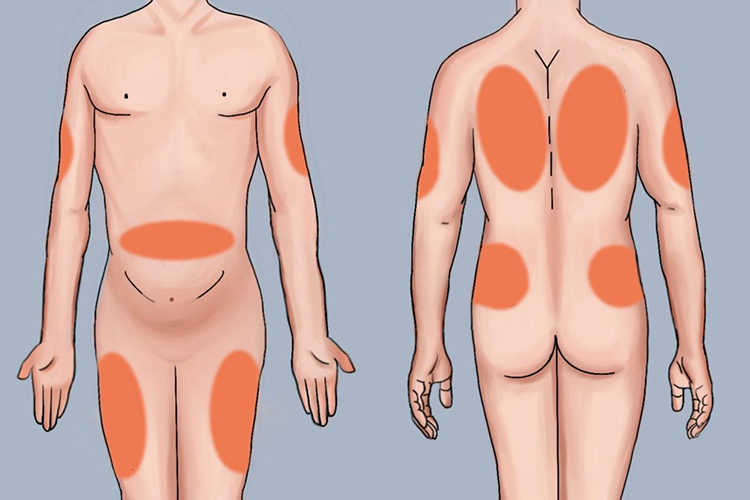 皮下注射部位图