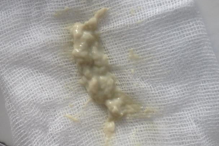 凝乳块状或豆渣样白带图 凝乳块状或豆渣样白带图