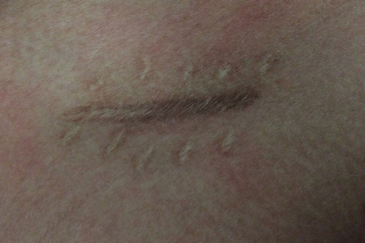 开腹阑尾切除术瘢痕图