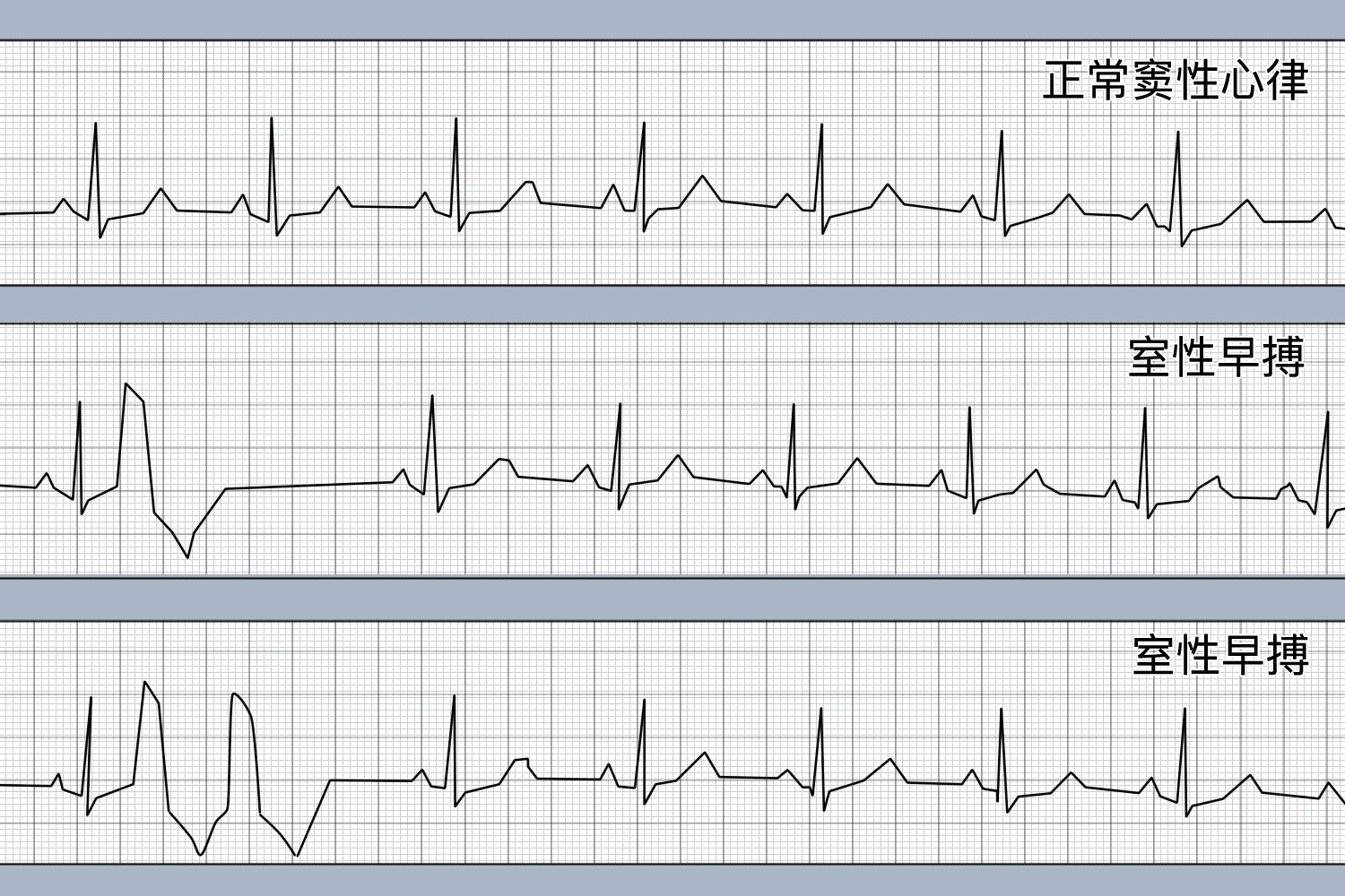 ront型室性早搏图片