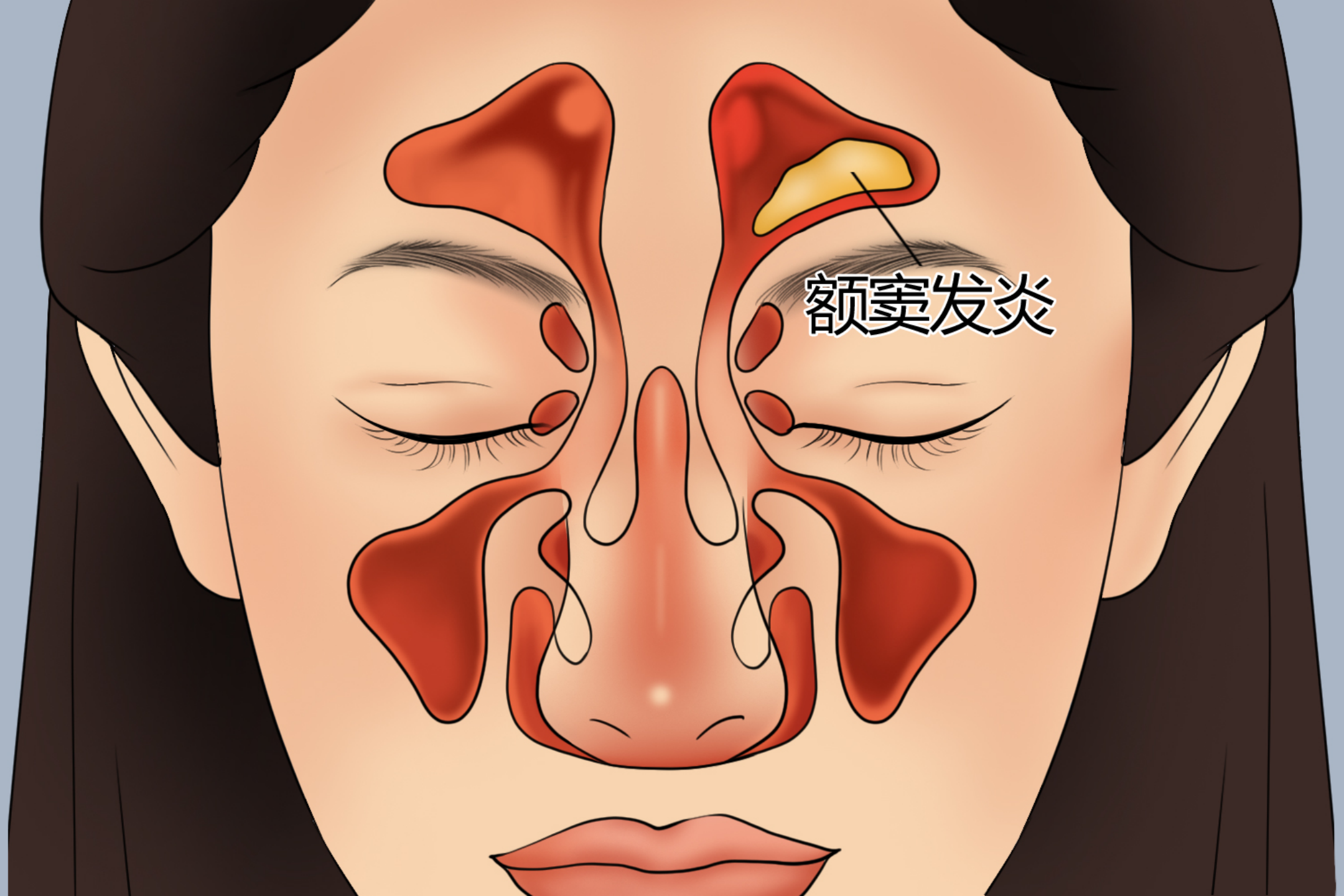 鼻窦炎病理改变图