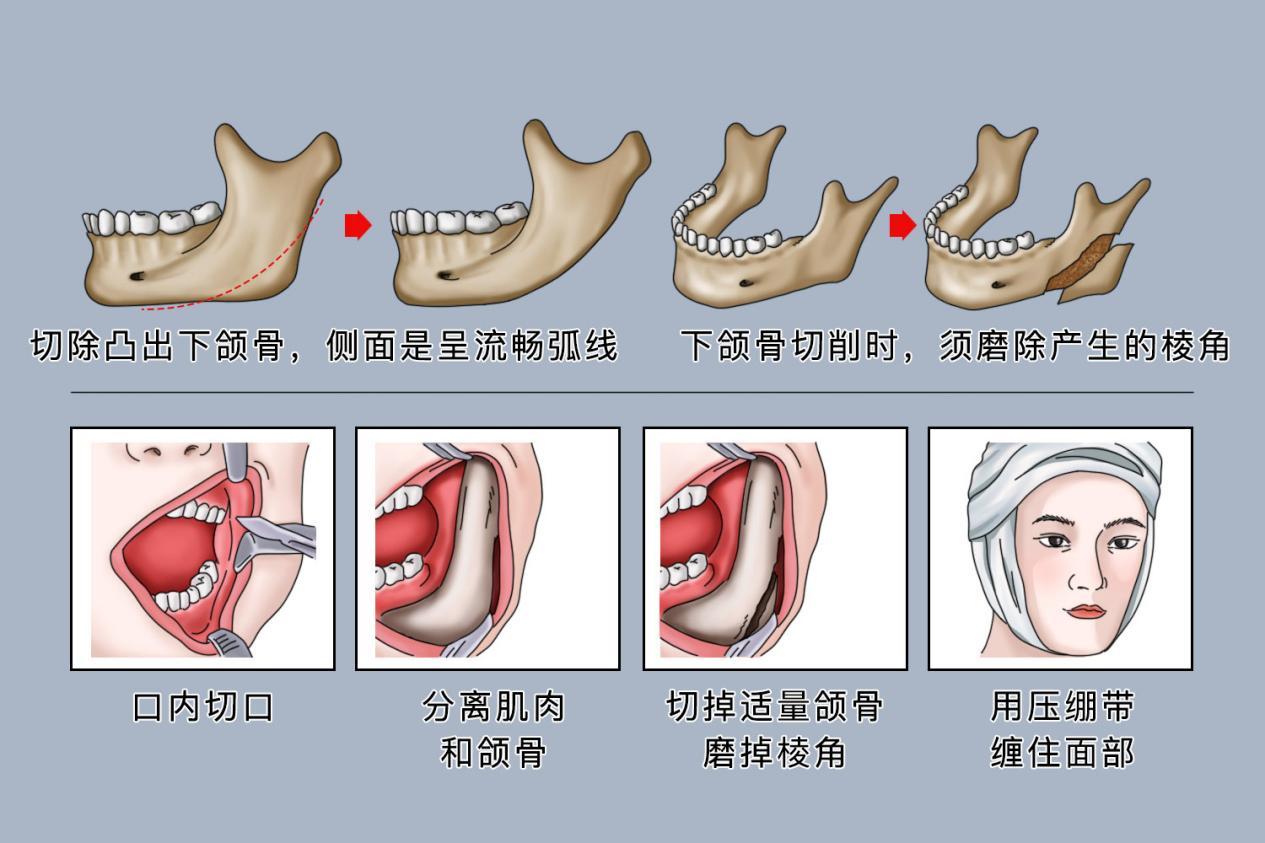 下颌角截骨术过程图
