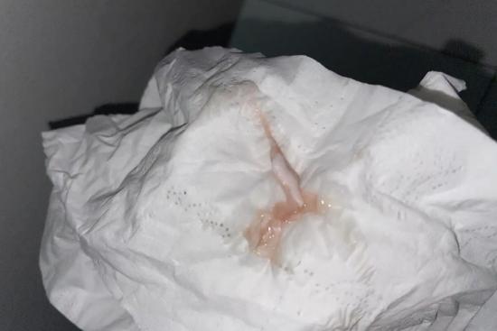 浅红色药渣样分泌物