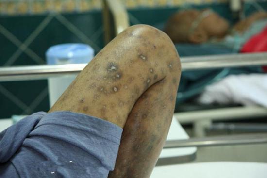 艾滋病身上黑斑图片