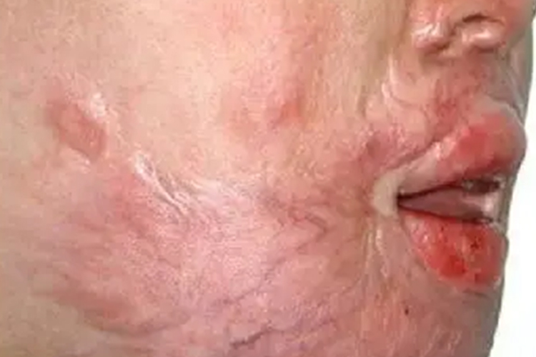 深Ⅱ度烫伤面部瘢痕6个月恢复图 深Ⅱ度烫伤面部瘢痕6个月恢复图