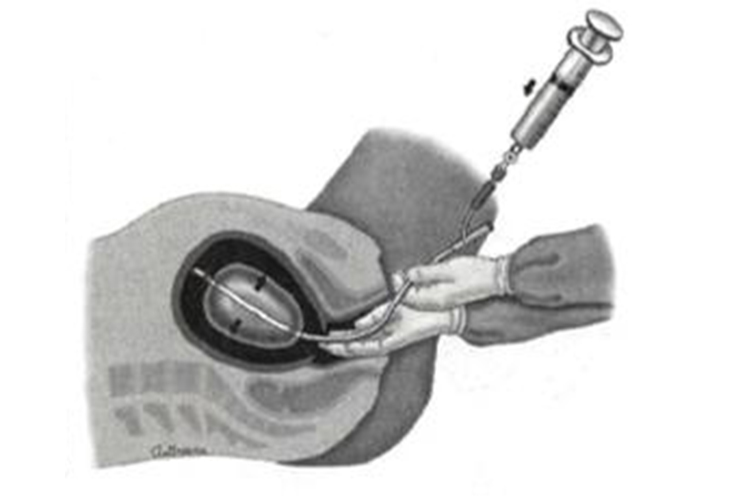 宫腔球囊放入图