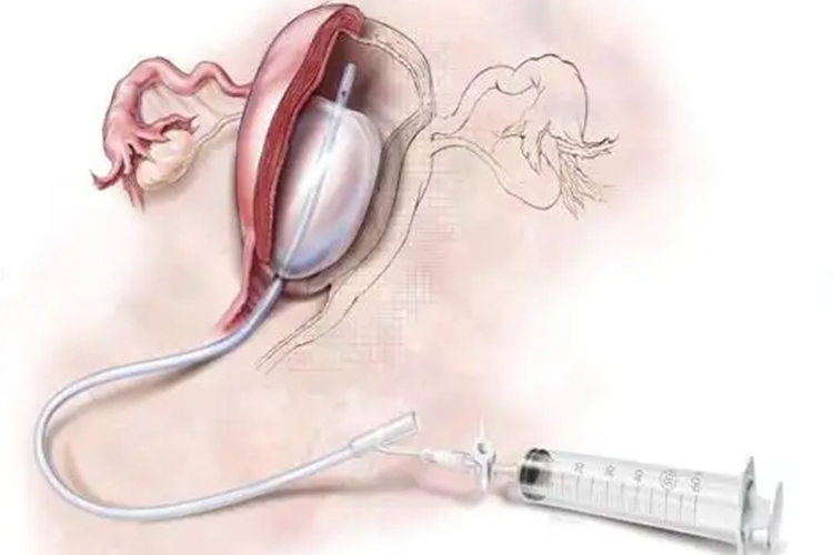 宫腔球囊取出图