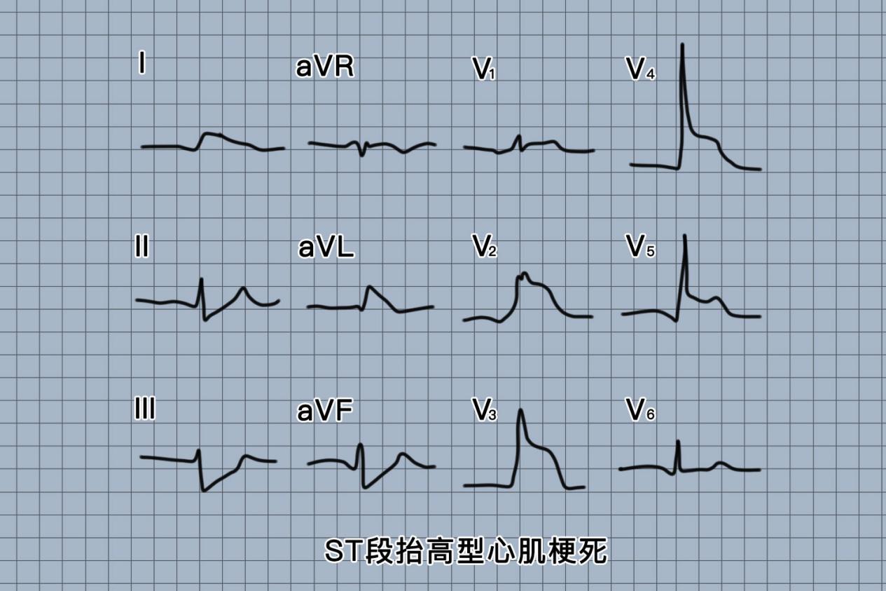 ST段抬高型心肌梗死心电图