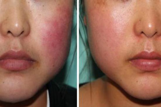 光子嫩肤去除红血丝效果图